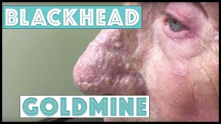 A Goldmine of Blackhead & Whitehead Extractions