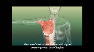 PFM Medical Mesh Implant : TiLOOP Bra Animation One Stage Reconstruction