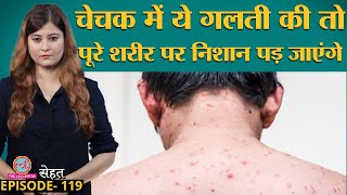 Chicken Pox जिसे माता निकलना कहते हैं, उसे लेकर बड़ी ग़लतफ़हमी दूर कर लीजिए | चेचक | Sehat ep 119