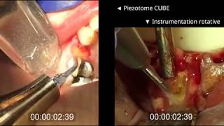 Extraction with the Piezotome® Cube VS with Traditional Instrumentation