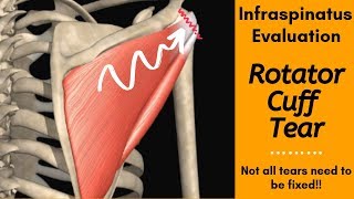 Infraspinatus Tear Evaluation: Special tests and Manual Muscle Testing