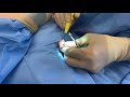 fixing a sagging chest with nipple lifting and male gland removal gynecomastia dr. jason emer