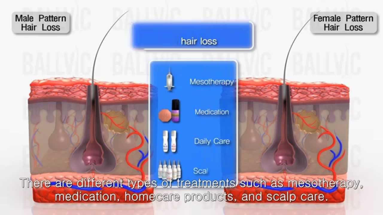 Different Types Of Hair Loss And The Treatment Methods - YouTube