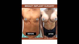 Breast Enlargement Before After | Breast Enhancement Before After