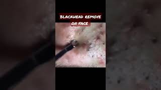 Popping huge blackheads and Pimple Popping - Best Pimple Popping Videos,#shorts