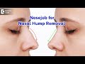 HUMP ON NOSE-How is it treated?| Nosejob | Rhinoplasty | Nasal Hump-Dr. Srikanth V | Doctors' Circle