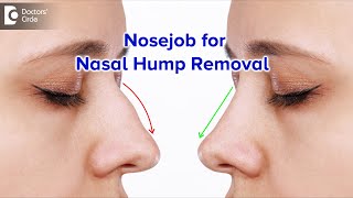 HUMP ON NOSE-How is it treated?| Nosejob | Rhinoplasty | Nasal Hump-Dr. Srikanth V | Doctors' Circle