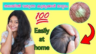 How to remove scalp acne at home || Natural Home remedies _SimplyMyStyle Unni #malayalambeautytips