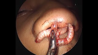 MAGGOTS in a 5yr Old kid | Maggots eating healthy tissue inside Nose