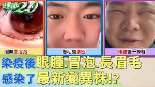 染疫後眼腫.冒泡.長眉毛 感染了最新變異株！？ 健康2.0