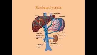 Approaching the GI Bleed - CRASH! Medical Review Series