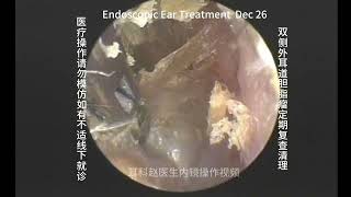 Regular cleaning and re examination of bilateral external auditory canal cholesteatoma 20241226