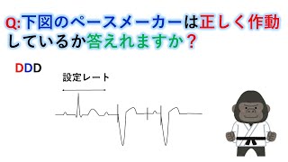 心電図：暗記からの卒業 69話 ペーシング不全