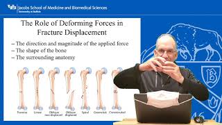 Common Fractures