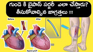 Coronary Artery ByPass Graft surgery(Animation video)/CABG/telugu