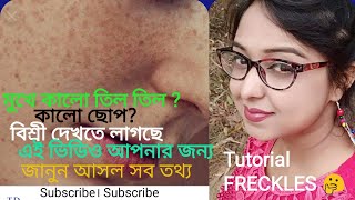 FRECKLES । Black spot । মুখে তিল । কালো দাগ । প্রাকৃতিক উপায়ে দূর করুন। কারণ। ধরন।সব কিছু জেনেনিন