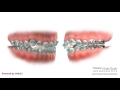 Class I Crowding - Braces - Orthodontic Treatment