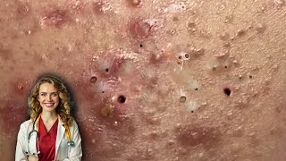 Popping Pimples And Blackheads - 141