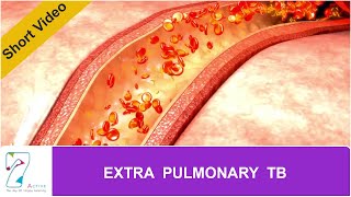 EXTRA PULMONARY TB