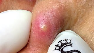 Big Pimples | Acne Treament Under The Skin #06 | Relax Every Day With Thuy Truong Sac Dep Spa | Acne