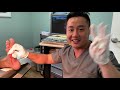 huge object pulled out of foot by dr. binh