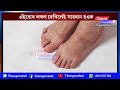 blood sugar signs যেতিয়া আপুনি আপোনাৰ ভৰিত এই 3 টা চিহ্ন দেখিব তেতিয়া সাৱধান হ ব