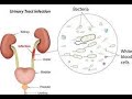 Urinary tract infections in children!