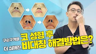 71화. 코성형수술 후 비대칭이 더 심해졌어요 (feat. 구순구개열)