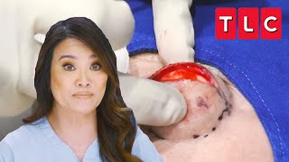 Dr. Lee Squeezes “Devil Horn” Cyst off the Forehead of a Patient | Dr. Pimple Popper | TLC
