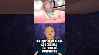 Los Injertos de Hueso funcionan así