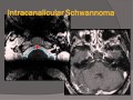 MedPix COW 647 - Neurofibromatosis Type 2, the MISME Syndrome