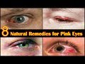 How to Get Rid of Pink Eye Fast at Home - 8 Home Remedies for Eye Infection