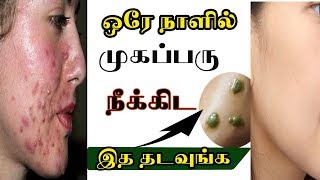 முகப்பரு ஒரே நாளில் நீங்க | How to Remove Pimples in One day ||