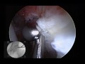 portal placement in hip arthroscopy