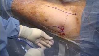 Portal Placement in Hip Arthroscopy