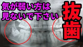 後悔しますよ！その親知らずの抜歯法知らないと…