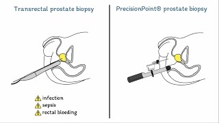 Prostate Biopsies Explained: Transrectal vs. PrecisionPoint®