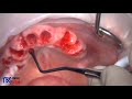 atraumatic extraction using frings®