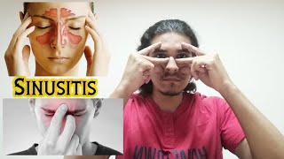 التهاب الجيوب الأنفية - أسبابه وأعراضه وأنواعه وعلاجه Sinusitis - causes, symptoms types \u0026 treatment