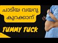 Tummy Tuck surgery (Abdominoplasty) in Kerala || Belly Fat Removal Surgery || Thrissur