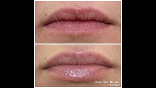 Lip Filler for a **NATURAL LOOK** with JUVÉDERM VOLBELLA® XC