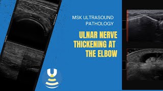 Thickened and symptomatic ulnar nerve at the elbow on ultrasound