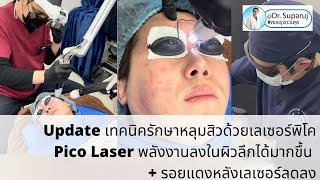 เทคนิครักษาหลุมสิวด้วยโปรแกรม Discovery Pico Laserพลังงานลงในผิวลึกมากขึ้น