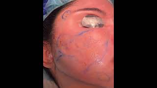 Acne scar treatment using the Taylor Liberator and Fotona SP Dynamis and StarWalker Laser’s