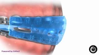 Sports Mouthguard (Braces Friendly)