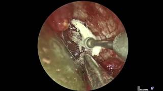 EndoscopicTransorbital removal of cavernous sinus dermoid