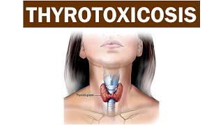 Thyrotoxicosis