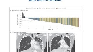 GRACEcast-100_Lung-Cancer_MM in LC Pt 5: Dr. Spigel on Incorporating Targets into Clinical Trials