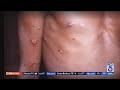 World Health Organization declares monkeypox a global emergency