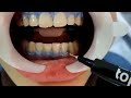 FGM Whiteness HP Maxx For Bleaching & Tooth Whitening - How To Use  - DENTBEAR